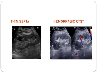 THIN SEPTA HEMORRAGIC CYST
 