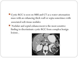 Cystic RCC is seen on MRI and CT as a water-attenuation
mass with an enhancing thick wall or septa sometimes with
associated soft-tissue nodules
 Nodular and septal enhancement is the most sensitive
finding to discriminate cystic RCC from complex benign
lesions .
 