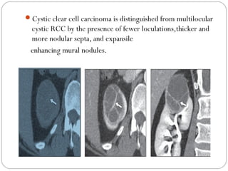 Cystic clear cell carcinoma is distinguished from multilocular
cystic RCC by the presence of fewer loculations,thicker and
more nodular septa, and expansile
enhancing mural nodules.
 