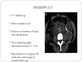 CATEGORY II F
 F = Follow up
 More complex cyst
 Increase in number of septa
and calcifications
 Non enhancing high
attenuation lesions > 3 cm
 May advance to category III
with time and require 6
month follow up
 