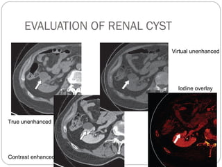 EVALUATION OF RENAL CYST
True unenhanced
Contrast enhanced
Virtual unenhanced
Iodine overlay
 
