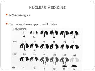 NUCLEAR MEDICINE
Tc 99m scintigram
Cyst and solid tumor appear as cold defect
 