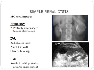 SIMPLE RENAL CYSTS
MC renal masses
ETIOLOGY
Probably secondary to
tubular obstruction
IVU
Radiolucent mass
Pencil thin wall
Claw or beak sign
USG
Anechoic with posterior
acoustic enhancement
 