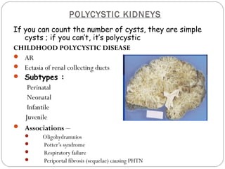 POLYCYSTIC KIDNEYS
If you can count the number of cysts, they are simple
cysts ; if you can’t, it’s polycystic
CHILDHOOD POLYCYSTIC DISEASE
 AR
 Ectasia of renal collecting ducts
 Subtypes :
Perinatal
Neonatal
Infantile
Juvenile
 Associations –
 Oligohydramnios
 Potter’s syndrome
 Respiratory failure
 Periportal fibrosis (sequelae) causing PHTN
 