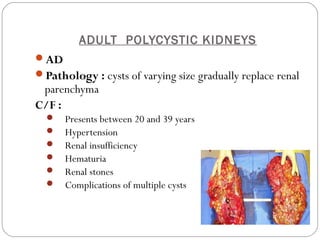 ADULT POLYCYSTIC KIDNEYS
AD
Pathology : cysts of varying size gradually replace renal
parenchyma
C/F :
 Presents between 20 and 39 years
 Hypertension
 Renal insufficiency
 Hematuria
 Renal stones
 Complications of multiple cysts
 