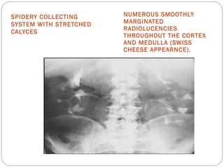 SPIDERY COLLECTING
SYSTEM WITH STRETCHED
CALYCES
NUMEROUS SMOOTHLY
MARGINATED
RADIOLUCENCIES
THROUGHOUT THE CORTEX
AND MEDULLA (SWISS
CHEESE APPEARNCE).
 