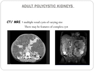 ADULT POLYCYSTIC KIDNEYS
CT/ MRI : multiple renal cysts of varying size
There may be features of complex cyst
 