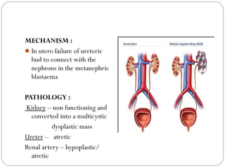 MECHANISM :
In utero failure of ureteric
bud to connect with the
nephrons in the metanephric
blastaema
PATHOLOGY :
Kidney – non functioning and
converted into a multicystic
dysplastic mass
Ureter – atretic
Renal artery – hypoplastic/
atretic
 
