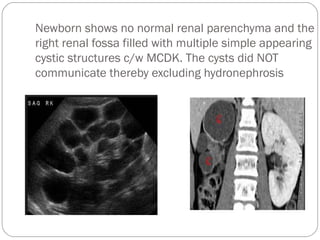 Newborn shows no normal renal parenchyma and the
right renal fossa filled with multiple simple appearing
cystic structures c/w MCDK. The cysts did NOT
communicate thereby excluding hydronephrosis
 