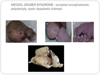 MECKEL GRUBER SYNDROME : occipital encephalocele,
polydactyly, cystic dysplastic kidneys
 