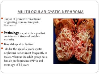 MULTILOCULAR CYSTIC NEPHROMA
Tumor of primitive renal tissue
originating from metanephric
blastaema
Pathology – cyst with septa that
contain renal tissue of variable
maturity
Bimodal age distribution.
 Under the age of 5 years, cystic
nephroma occurs most frequently in
males, whereas the adult group has a
female predominance (91%) and
mean age of 55 years
 