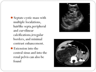 Septate cystic mass with
multiple loculations,
hairlike septa,peripheral
and curvilinear
calcifications,irregular
borders, and minimal
contrast enhancement.
Extension into the
central sinus and into the
renal pelvis can also be
found
 