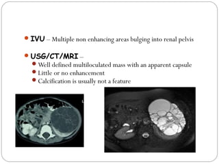 IVU – Multiple non enhancing areas bulging into renal pelvis
USG/CT/MRI –
Well defined multiloculated mass with an apparent capsule
Little or no enhancement
Calcification is usually not a feature
 