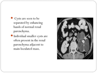  Cysts are seen to be
separated by enhancing
bands of normal renal
parenchyma.
Individual smaller cysts are
often present in the renal
parenchyma adjacent to
main loculated mass.
 