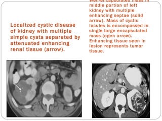 Localized cystic disease
of kidney with multiple
simple cysts separated by
attenuated enhancing
renal tissue (arrow).
Well-encapsulated mass in
middle portion of left
kidney with multiple
enhancing septae (solid
arrow). Mass of cystic
locules is encompassed in
single large encapsulated
mass (open arrow).
Enhancing tissue seen in
lesion represents tumor
tissue.
 