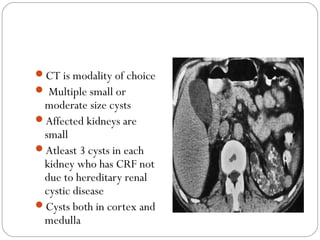 CT is modality of choice
 Multiple small or
moderate size cysts
Affected kidneys are
small
Atleast 3 cysts in each
kidney who has CRF not
due to hereditary renal
cystic disease
Cysts both in cortex and
medulla
 