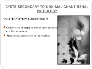 CYSTS SECONDARY TO NON MALIGNANT RENAL
PATHOLOGY
OBLITERATIVE PYELONEPHRITIS
Constriction of major or minor calyx produces
cyst like structures
 Similar appearance seen in tuberculosis
 