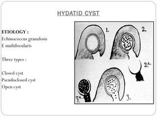 HYDATID CYST
ETIOLOGY :
Echinococcus granulosis
E multilocularis
Three types :
Closed cyst
Pseudoclosed cyst
Open cyst
 