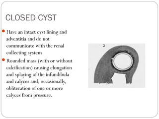 CLOSED CYST
Have an intact cyst lining and
adventitia and do not
communicate with the renal
collecting system
Rounded mass (with or without
calcification) causing elongation
and splaying of the infundibula
and calyces and, occasionally,
obliteration of one or more
calyces from pressure.
 