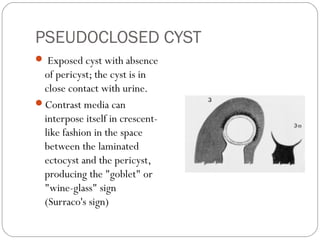 PSEUDOCLOSED CYST
 Exposed cyst with absence
of pericyst; the cyst is in
close contact with urine.
Contrast media can
interpose itself in crescent-
like fashion in the space
between the laminated
ectocyst and the pericyst,
producing the "goblet" or
"wine-glass" sign
(Surraco's sign)
 