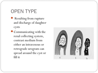 OPEN TYPE
 Resulting from rupture
and discharge of daughter
cysts
Communicating with the
renal collecting system,
contrast medium from
either an intravenous or
retrograde urogram can
spread around the cyst or
fill it 
 