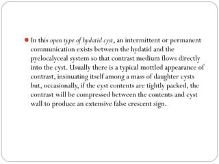 In this open type of hydatid cyst, an intermittent or permanent
communication exists between the hydatid and the
pyelocalyceal system so that contrast medium flows directly
into the cyst. Usually there is a typical mottled appearance of
contrast, insinuating itself among a mass of daughter cysts
but, occasionally, if the cyst contents are tightly packed, the
contrast will be compressed between the contents and cyst
wall to produce an extensive false crescent sign.
 