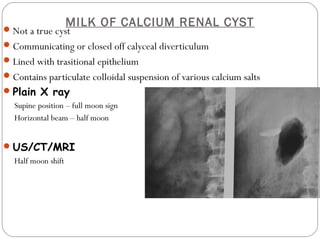MILK OF CALCIUM RENAL CYST
Not a true cyst
Communicating or closed off calyceal diverticulum
Lined with trasitional epithelium
Contains particulate colloidal suspension of various calcium salts
Plain X ray
Supine position – full moon sign
Horizontal beam – half moon
US/CT/MRI
Half moon shift
 
