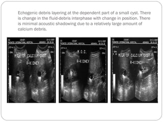 Echogenic debris layering at the dependent part of a small cyst. There
is change in the fluid-debris interphase with change in position. There
is minimal acoustic shadowing due to a relatively large amount of
calcium debris.
 