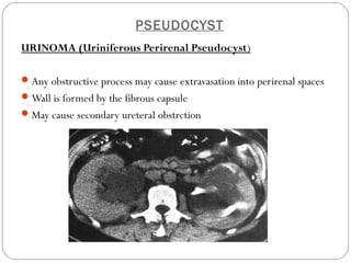 PSEUDOCYST
URINOMA (Uriniferous Perirenal Pseudocyst)
Any obstructive process may cause extravasation into perirenal spaces
Wall is formed by the fibrous capsule
May cause secondary ureteral obstrction
 