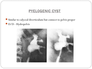PYEL0GENIC CYST
Similar to calyceal diverticulum but connect to pelvis proper
D/D - Hydropelvis
 