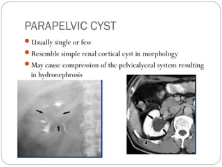 PARAPELVIC CYST
Usually single or few
Resemble simple renal cortical cyst in morphology
May cause compression of the pelvicalyceal system resulting
in hydronephrosis
 