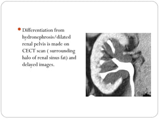 Differentiation from
hydronephrosis/dilated
renal pelvis is made on
CECT scan ( surrounding
halo of renal sinus fat) and
delayed images.
 