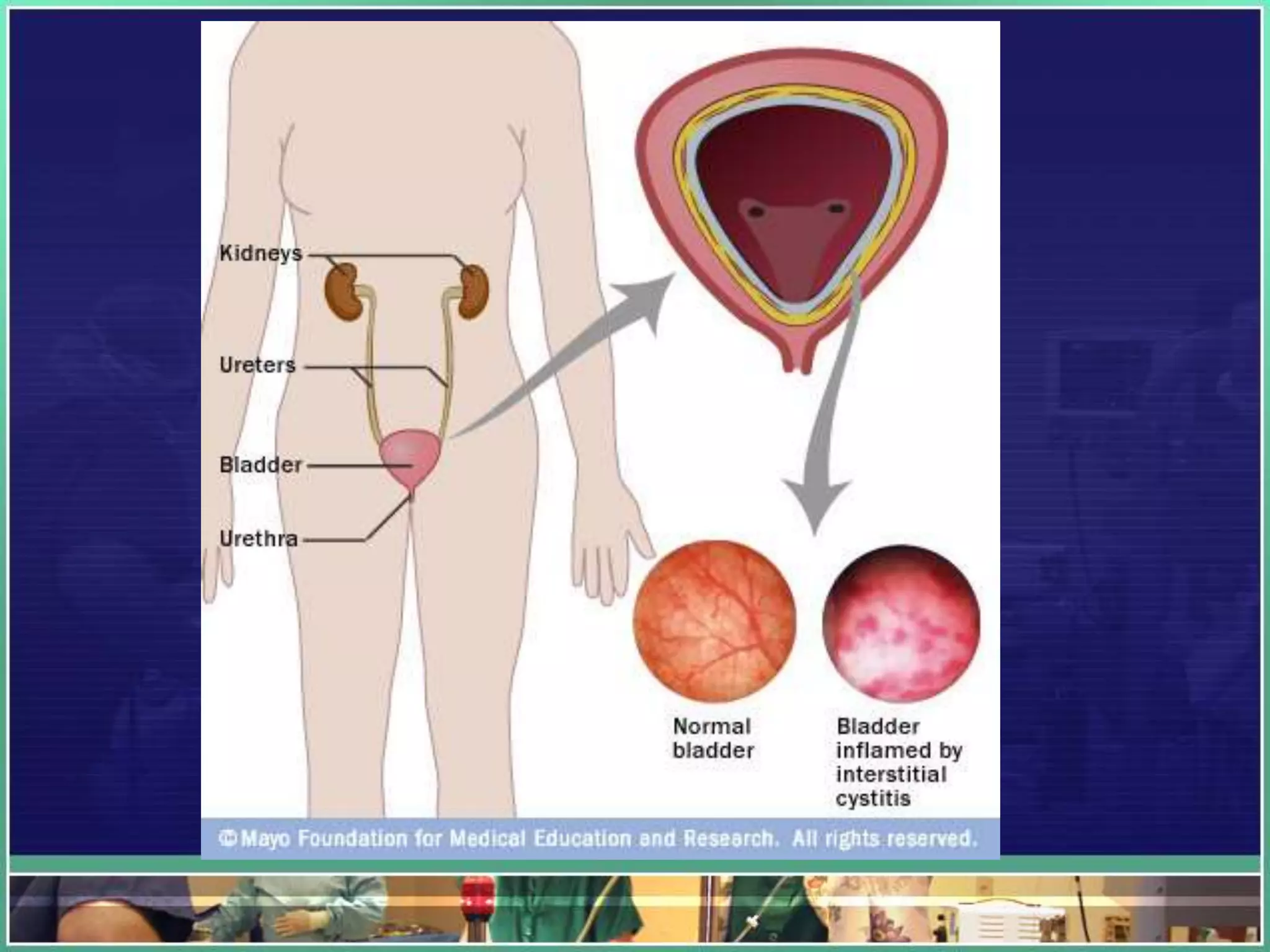 Cystitis INFLAMMATION OF URINARY BLADDER | PPTX