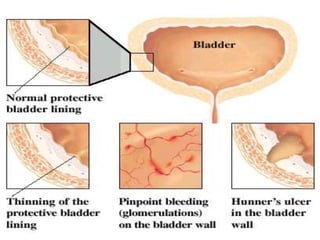Simple Cystitis Cystitis made easy | PPTX