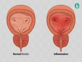 Cystitis Damage cystitis.pptx