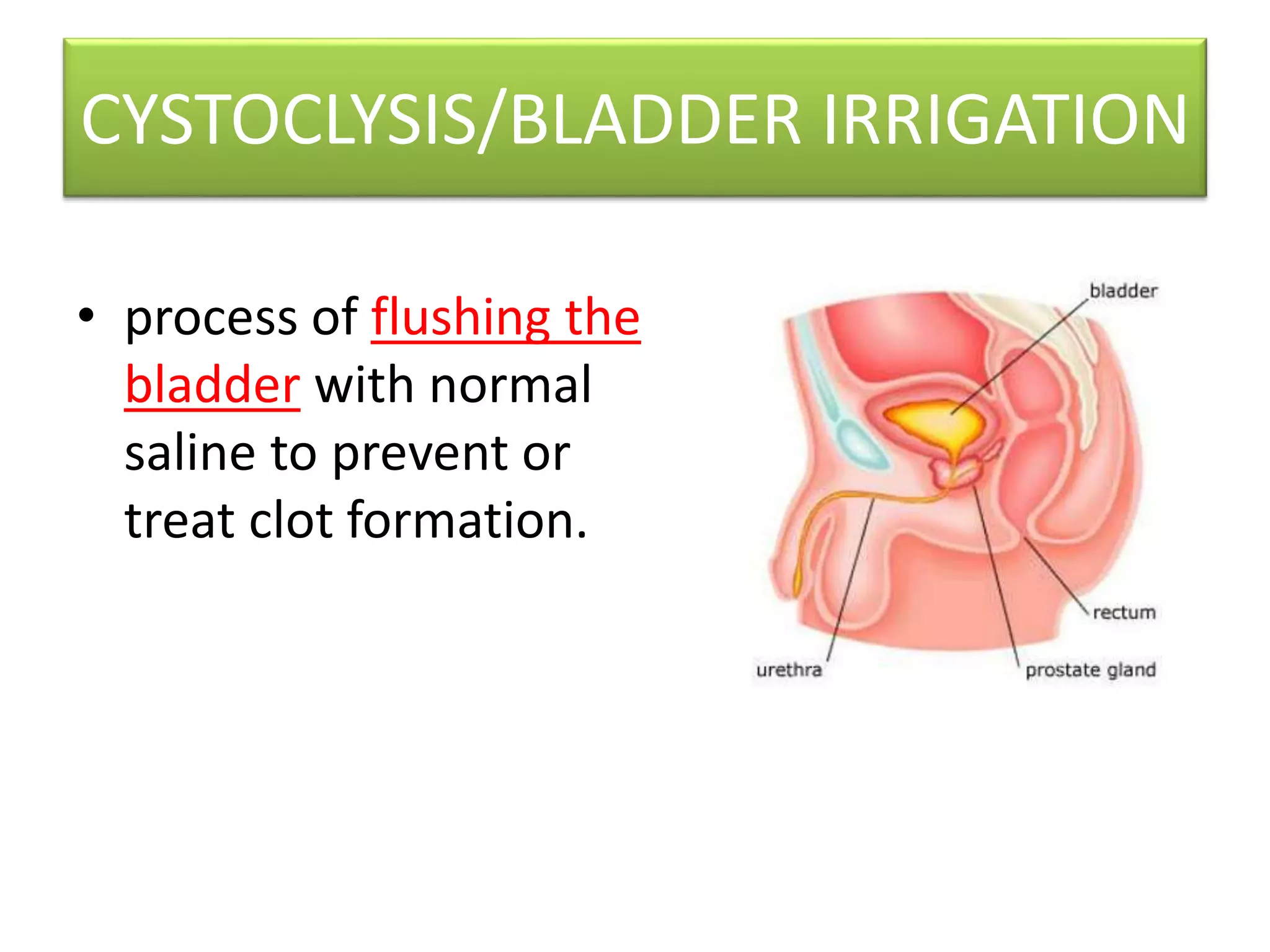 Cystoclysis bladder irrigation | PPTX