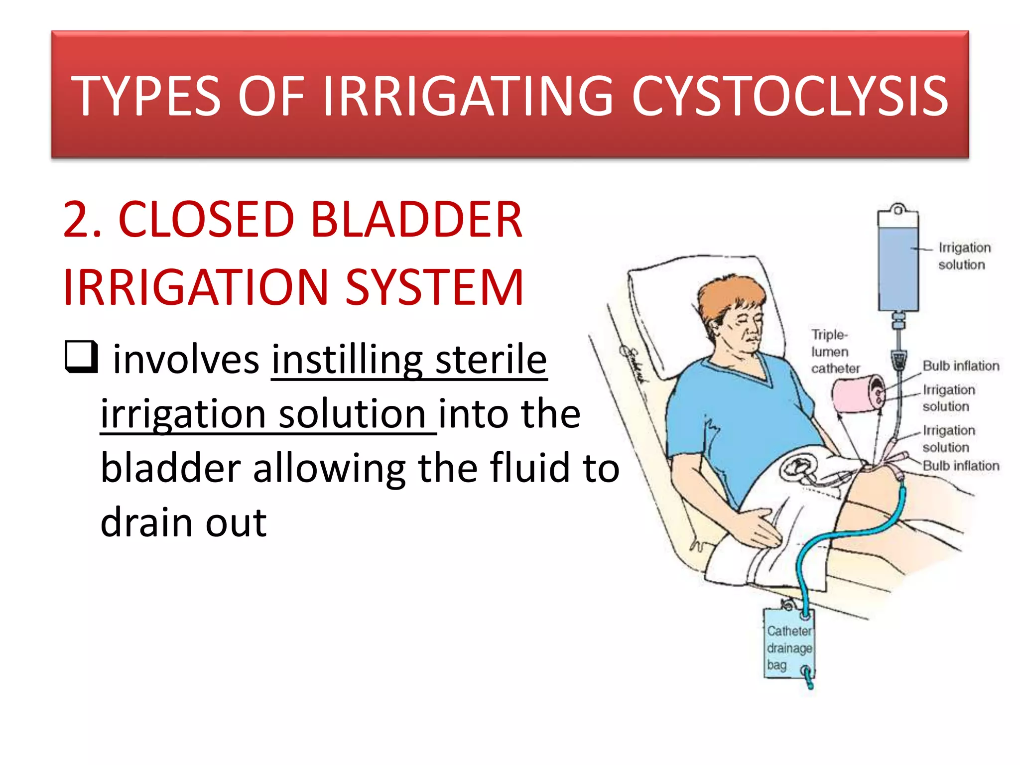 Cystoclysis bladder irrigation