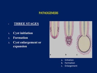cysts of the oral and maxillofacial region | PPTX