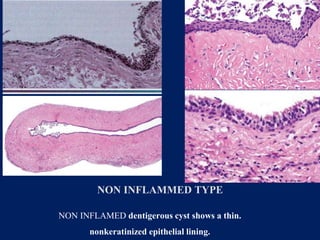 Non Inflamed cysts of the oral and maxillofacial region | PPTX