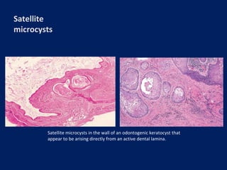 cysts of the oral and maxillofacial region | PPTX