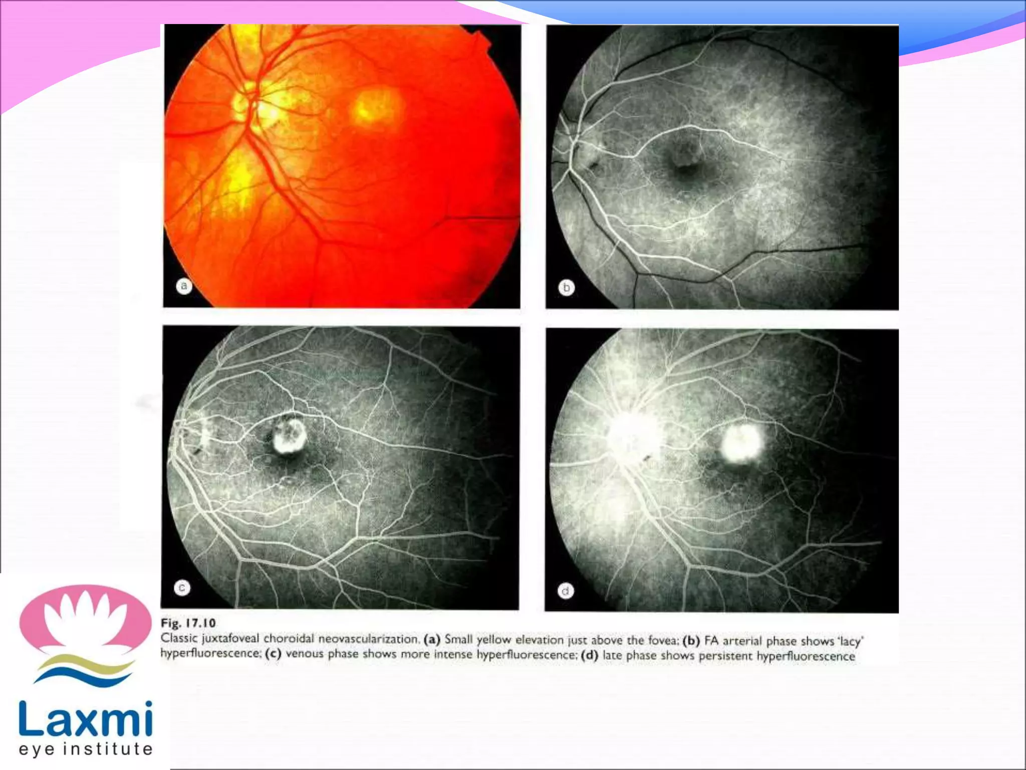 Cystoid macular oedema | PPTX