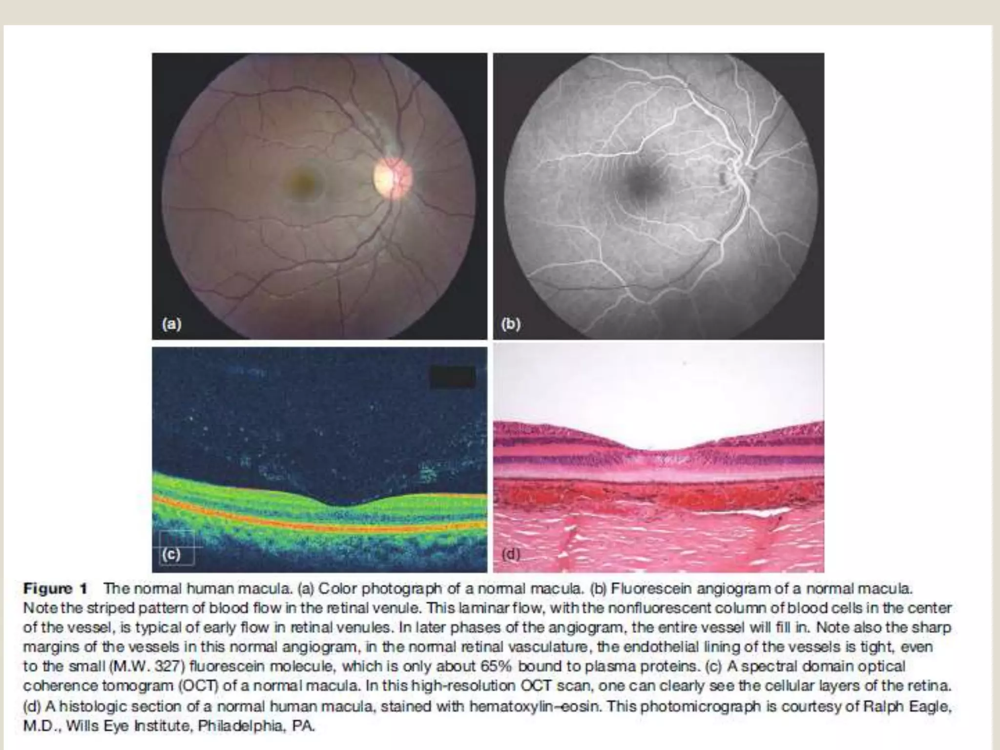 Cystoid macular oedema | PPTX