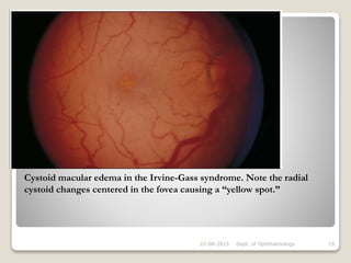 22-08-2015 Dept. of Ophthalmology 19
Cystoid macular edema in the Irvine-Gass syndrome. Note the radial
cystoid changes centered in the fovea causing a “yellow spot.”
 