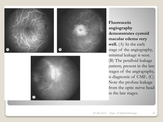 Fluorescein
angiography
demonstrates cystoid
macular edema very
well. (A) In the early
stage of the angiography,
minimal leakage is seen.
(B) The petalloid leakage
pattern, present in the late
stages of the angiography,
is diagnostic of CME. (C)
Note the profuse leakage
from the optic nerve head
in the late stages.
22-08-2015 Dept. of Ophthalmology 23
 