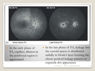  In the early phase of
FA, capillary dilation in
the perifoveal region is
appreciated
22-08-2015 Dept. of Ophthalmology 24
 In the late phase of FA, leakage into
the cystoid spaces is distributed
radially in Henle’s layer forming the
classic petaloid leakage pattern or
expansile dot appearance
 