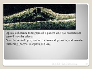 22-08-2015 Dept. of Ophthalmology 28
Optical coherence tomogram of a patient who has postcataract
cystoid macular edema.
Note the central cysts, loss of the foveal depression, and macular
thickening (normal is approx 212 μm)
 