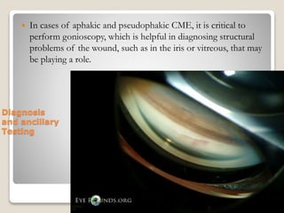 Diagnosis
and ancillary
Testing
 In cases of aphakic and pseudophakic CME, it is critical to
perform gonioscopy, which is helpful in diagnosing structural
problems of the wound, such as in the iris or vitreous, that may
be playing a role.
22-08-2015 Dept. of Ophthalmology 29
 
