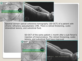 22-08-2015 Dept. of Ophthalmology 54
Spectral domain optical coherence tomography (SD-OCT) of a patient with
chronic refractory pseudophakic CME. There is retinal thickening, cystic
intraretinal lesions, and subretinal fluid.
SD-OCT of the same patient 1 month after a sub-Tenon's
injection of triamcinolone. The retinal thickening, cystic
lesions, and subretinal fluid have improved
 