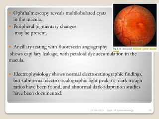  Ophthalmoscopy reveals multilobulated cysts
in the macula.
 Peripheral pigmentary changes
may be present.
 Ancillary testing with fluorescein angiography
shows capillary leakage, with petaloid dye accumulation in the
macula.
 Electrophysiology shows normal electroretinographic findings,
but subnormal electro-oculographic light peak–to–dark trough
ratios have been found, and abnormal dark-adaptation studies
have been documented.
22-08-2015 Dept. of Ophthalmology 78
 