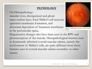 PATHOLOGY
 On Histopathology-
macular cysts, disorganized and gliotic
inner nuclear layer, focal Müller's cell necrosis,
epiretinal membrane formation, and
abnormal deposition of basement membrane
in the perivascular space.
Degenerative changes also have been seen in the RPE and
photoreceptors of the macula. Histopathological features seen
in dominantly inherited cystoid macular edema, namely the
involvement of Müller's cells, are quite different from those
features seen in cystoid macular edema secondary to other
causes.
22-08-2015 Dept. of Ophthalmology 79
 